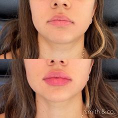 Lip Filler Before And After Round Lips, Lip Filler Bottom Lip Bigger, Lip Filler Round Lips, Small Round Lips, Lip Filler On Small Mouth, Angelina Jolie Lip Filler, Lips Fillers Shapes, Pout Lip Filler, Natural Lip Fillers 1ml