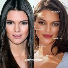 Lips Before And After, Before And After Makeup Transformation, Before And After Contouring, Jawline Contour, Contrast Makeup, Facial Harmony, Face Injections, Contour Nose, Face Construction