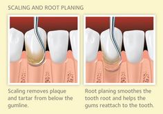 Dentaltown - Scaling and Root Planing. Scaling removes plaque and tartar from below the gumline. Root Planing smoothes the tooth root and helps gums reattach to the tooth. This is also known as periodontal therapy, non-surgical periodontal therapy, or a deep cleaning. Dental Assistant School, Tooth Extraction Healing, Dental Nurse, Registered Dental Hygienist