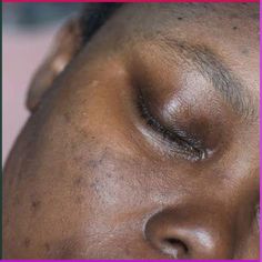 Hyperpigmentation can take varying amounts of time to fade away, depending on several factors, such as: 1. Type and severity: Different types of hyperpigmentation, like melasma, post-inflammatory hyperpigmentation (PIH), or sunspots, have different fading times. 2. Treatment: Professional treatments like chemical peels, microdermabrasion, or laser therapy can accelerate fading. 3. Skincare routine: Consistent use of products containing ingredients like vitamin C, niacinamide, or retinoids ... Post Inflammatory Hyperpigmentation, Chemical Peels, Laser Therapy, Chemical Peel, Younger Looking Skin, Healthy Skin Care, Skin Tips, Radiant Skin