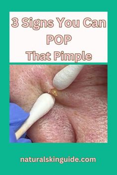 Wondering if it's ever beneficial to pop a pimple? You're not the only one. So we did a deep dive and have the pimple popping guide you need. Hard Pimple, Lip Pimple, Head Pimples, Dry Out Pimples, Big Pimple, Cystic Pimple, Vegan Probiotics