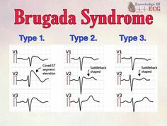 an image of the types of blood pressures in bragad syndrome type 1, type 2 and type 3