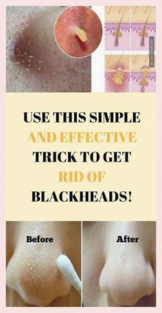 Remove Blackheads by Tracey James | This newsletter was created with Smore, an online tool for creating beautiful newsletters for educators, businesses and more Small Pimples, To Remove Blackheads, Clean Blackheads, Rid Of Blackheads, Mascara Eyeliner, Facial Wrinkles, Remove Blackheads, Home Beauty Tips, Skin Tags