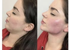 Lighter Brown Hair, Nose Surgery Rhinoplasty, Rhinoplasty Nose Jobs, Face Fillers, Face Surgery, Face Proportions, Face Lift Surgery, Facial Fillers, Facial Contouring