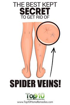 natural treatment for back pain What Causes Warts, Home Remedies For Spiders, Varicose Vein Remedy, Get Rid Of Spiders, Top 10 Home Remedies, Cold Medicine, Tongue Health, Natural Therapy, Trening Pilates