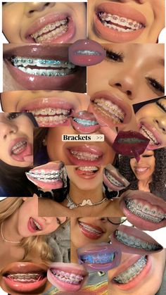 many different pictures of people with braces on their teeth