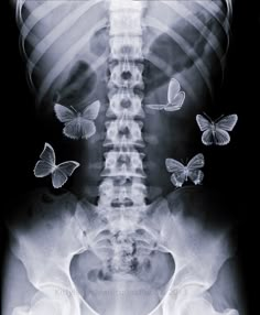 an x - ray shows butterflies flying over the back of a skeleton