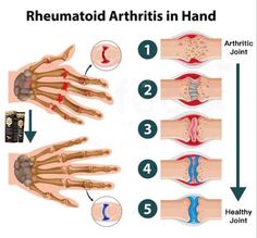 Bone Diseases, Healthy Joints, Poor Posture, Bone Health, Montana