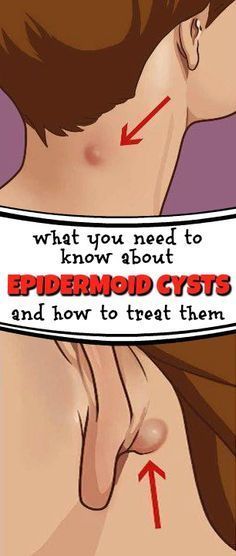 How to get rid of epidermoid cysts naturally. Learn more! Skin Bumps, Natural Therapy, Dr Oz, Beauty Blender, Detox Drinks, Health Problems