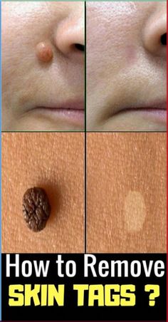 Skin Tags How To Get Rid Of, Skin Tags Removal Overnight, Wart Remedies, Herbs Medicine, Remove Skin Tags, Remove Skin Tags Naturally, Warts Remedy, Netflix Codes, Wellness Selfcare