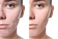 How To Treat Acne Revolution Aesthetics Acne Reasons, Acne Laser, Diy Acne, Aesthetic Clinic, Acne Facial, Acne Scar Removal, Skin Care Clinic, Scar Removal, Acne Skin