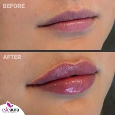 1ml Lip Filler, Fuller Lips Naturally, Plumper Lips, Lip Maximizer