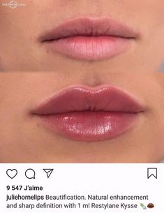 Lip Blush And Filler, Lip Injections Inspiration, Sydney Sweeney Lips, Lip Filler 2ml, Perfect Lips Injections, .5 Lip Filler, Lip Filler On Small Lips