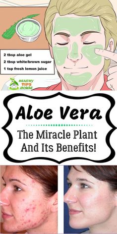 Aloe Vera Acne, Acne Home Remedies, Aloe Vera For Skin, Mask For Dry Skin, Remove Warts, Aloe Vera Face Mask, Acne Face Mask