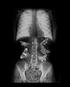 an x - ray shows the chest with butterflies on it's back and side