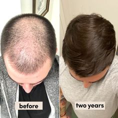 "I always had to keep my hair length extremely short. Now, I am able to grow it out and have healthy, thicker hair! My experience has been nothing but amazing. Once I ordered the products, shipping was extremely fast and efficient, and it has been every single month since. During the pandemic, Hims even re-shipped one of my orders since I was not home for a month! It has 100% boosted my confidence.” - Edward Thicker Healthier Hair, Hydra Facial, Hair System, Healthier Hair, Mens Hair, For Hair Growth, For Hair, Hair Growth, Background Design