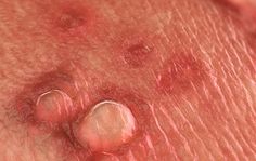 7 Things You Should Know About Genital Warts [Warning: Graphic Pics] | Women's Health Skin Tags On Face, Skin Wars, Warts On Face, Home Remedies For Warts, Remove Skin Tags Naturally, Warts Remedy, Get Rid Of Warts, Blemish Remover, Body Hair Removal