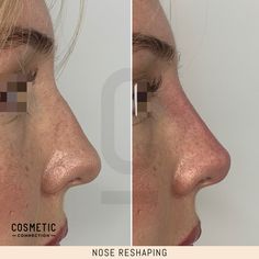 The Non-Surgical Rhinoplasty (nose reshaping) is a safe, effective way to enhance your nose using dermal filler. If you've been thinking about getting a nose job but have been worried about the risks and costs associated with traditional rhinoplasty surgery, then this might be a viable option for you.⁠ ⁠ If you’re ready to book a in for Nose Reshaping, then follow the link in the bio to secure your appointment today!⁠ ⁠ Confidence looks good®⁠ Tinkerbell Nose, Non Surgical Rhinoplasty, Nose Filler, Nose Fillers, Nose Tip, Rhinoplasty Surgery