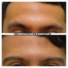 This 22-year-old man is shown before and 2.5 years after an eyebrow transplant to principally help with his central and lateral hair loss. 22 Years Old