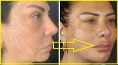 before and after photos of a woman's face with lines drawn on her cheek