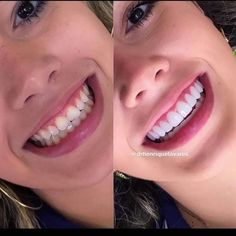 Home Dental Health: DIY Techniques for Tartar Removal #TartarRemoval #DentalCare #OralHealth #DentalHygiene #Tartar #HealthyTeeth #OralCare #DentalTips #TartarPrevention #SmileCare Natural Teeth Whitening Diy, Pretty Teeth, Veneers Teeth, Teeth Whitening Diy, Beautiful Teeth, Perfect Teeth, Teeth Braces, Dental Veneers, Smile Teeth