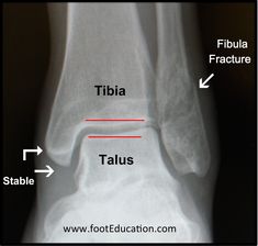 an x - ray view of the foot and ankle showing tibia, stabale, fibula, and stibalus