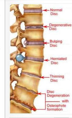 ¿Tengo una hernia de disco? Descubre más en: https://ideonn.wordpress.com/2015/07/21/tengo-una-hernia-discal/ Fuente: Encontrado en essentialoilspedia.com Bolesti Chrbta, Bulging Disc, Back Pain Remedies, Spine Health, Sciatica Pain, Medical Anatomy, Sciatic Nerve, Chiropractic Care, Medical Knowledge