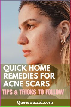 Looking for quick and natural solutions to fade acne scars? Discover the best home remedies that can help reduce scars and improve your skin's appearance. These easy, DIY treatments use common ingredients like aloe vera, lemon juice, and honey to give your skin a natural glow. Save this pin for your next skincare routine! Thicker Eyebrows Makeup, Acne Scar Remedies, Scar Remedies, Remedies For Acne, Natural Acne, Home Remedies For Acne, Types Of Acne, Acne Remedies