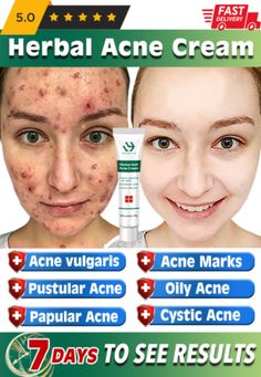 (eBay) Find many great new & used options and get the best deals for Acne Pimple Scare Marks Spots Removal Cream Natural Face Skin Repair Herbal Gel at the best online prices at eBay! Free shipping for many products! Acne Model, Cystic Acne Remedies, Blind Pimple, Forehead Acne, Pimples Under The Skin, Acne Gel, Acne Vulgaris, Natural Acne Remedies, Gentle Skin Cleanser