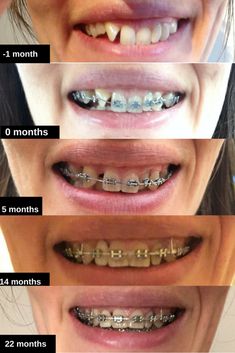 Braces Types, Dream Teeth, Before And After Braces, Aesthetic Teeth, Braces Problems, Braces Before And After, Orthodontics Teeth, Damon Braces, After Braces