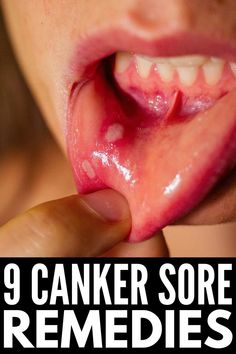 If you and/or your kids are prone to canker sores in your mouths, these canker sore remedies offer fast-acting relief. Canker Sore Remedies, Canker Sore Remedy, Best Cough Remedy, Canker Sore, Cold Sores Remedies, Health And Fitness Magazine, Oral Care Routine, Receding Gums, Cold Home Remedies