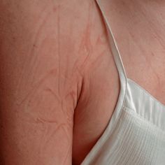 the back of a woman's breast showing signs of blemish on it