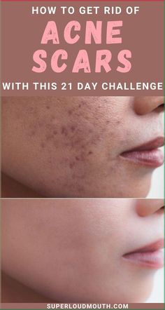 Try this 21 day challenge to cure acne scars naturally with home remedies Annoying Things, Acne Overnight, Acne Dark Spots, Dark Spots On Face, Get Rid Of Acne, Rid Of Acne, Natural Face Skin Care, Natural Acne Remedies, Home Remedies For Acne