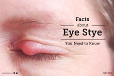 What Causes A Stye In Your Eye, Stye Remedies Fast How To Get Rid, Eye Sty, Stye Causes