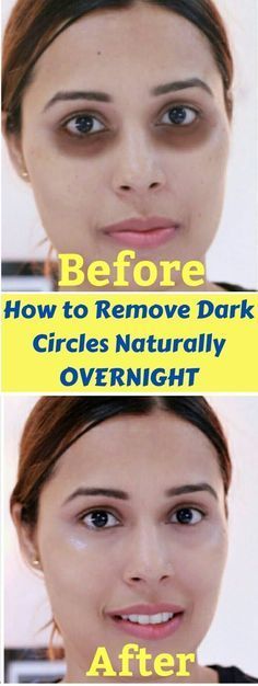 How To Remove Pigmentation From Nose Dark Circle Remedies Overnight, Eye Circle Remedies, Dark Circles Around Eyes, Dark Circle Remedies, Cucumber On Eyes, Under Eye Circles, Eye Wrinkles, Dark Eye Circles, Natural Skin Care Remedies