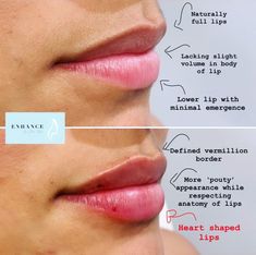 Lip Filler Before And After 1ml Juvederm, Heart Shaped Lip Filler, Lips Injections Shapes, Different Lip Filler Shapes, Lip Injections Shapes, Lip Fillers Shapes, Keyhole Lips, Lip Injections Juvederm, 0.5 Ml Lip Filler Before And After