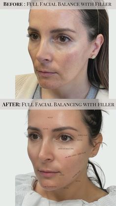 Radiesse Before After, Sculptra Filler, Morpheus 8, Best Collagen, Aesthetic Dermatology