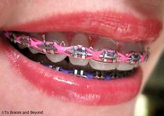 Power Chain Braces, Braces Girl, Braces Color Wheel, Red Braces, Adult Braces