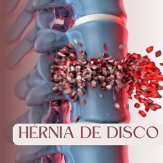 A hérnia de disco lombar é uma condição que afeta milhões de pessoas, causando dores e limitações sérias. Mas a boa notícia é que 90% dos casos podem ser tratados com sucesso! Com a técnica New Seitai utilizo técnicas específicas e instrumentos especializados para tratar a hérnia de disco de forma individualizada. As manobras promovem a coaptação discal, abrindo espaço entre as vértebras e aliviando a pressão sobre os nervos. Nas sessões, é possível observar melhora significativa nos sintom...