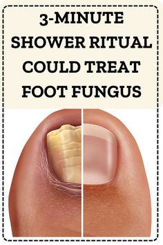 7 Day challenge-This mixture wipes out Toenail fungus!! Antifungal Cream, Fast Nail, Fungal Infection, Nail Fungus