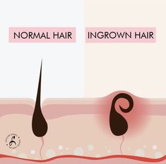 Ingrown hairs occur when a growing hair meets a blocked skin pore and turns back on itself, growing inward instead 😂 How to prevent this? The solution is to kill the hair at the root with laser hair removal ✨ Schedule a free consultation with us! 📩 @lessagelaserspa #depilacionlaser #lasehairremoval #depilaciondefinitiva #queensny #latinosenusa Ig Content Ideas, Natural Hair Removal Remedies, Skin Facts, Growing Hair, Hair Removal Methods, Ingrown Hairs, Skin Pores, Unwanted Hair Removal, Normal Hair