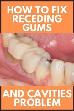 Fix Receding Gums, Teeth Decay, Baby Bottle Tooth Decay, Teeth Whitening Diy, Health Care Tips