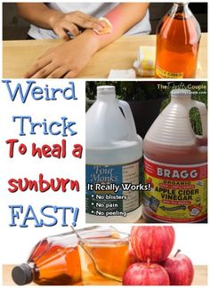 Sunburn Face Remedy, Severe Sunburn Relief, Best Sunburn Remedy, Sunburn Remedies Apple Cider Vinegar, Sunburn Relief Instant Diy, Vinegar For Sunburn Relief, How To Heal Sunburn Fast, Sun Burn Remedy Overnight, Home Remedy For Sunburn