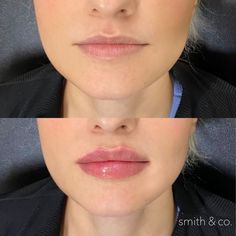 Lip Inspo Filler, Lip Fillers Before And After, Lip Filler Before And After, Lip Filler Shape Ideas, Desired Lips, Lip Filler Inspiration, Botox Before And After, Lips Inspiration