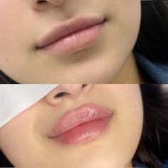 Bow Shaped Lips Filler, Lip Filler Types, Lip Injections Before And After 0.5ml, Lip Filler Inspo 1 Ml, Lip Filler Inspo 0.5ml, Lip Flip Results, Lip Filler 1 Ml, 0.5 Lip Filler, Round Lips Filler