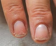 Nail Remedies, Nails After Acrylics, Cracked Nails, Peeling Nails, Weak Nails, Broken Nails, Nail Repair, Damaged Nails