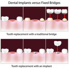 Dental Bridge Cost, Teeth Bonding, Oral Health Education, Dental Bonding, Tooth Replacement, Dental Bridge, Tooth Extraction, Dental Crowns