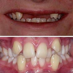 GUARANTEED! Whiten Your Yellow Teeth In Less Than 2 Minutes! https://theunknownremedy.com/guaranteed-whiten-your-yellow-teeth/ Permanent Dentures, Teeth Aesthetic, Straight Smile, Plaque Teeth, Crooked Teeth, Front Teeth, Missing Teeth