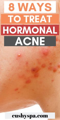 Needs some tips on how to treat hormonal acne naturally? Learn about why you even have it and start using natural products to cure it. Treat Hormonal Acne, Pimple Free Skin, Forehead Acne, Bad Acne, Skin Lightener, Natural Acne Remedies, Stomach Problems