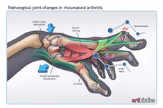 an image of the wrist and hand with labeled parts labelled on it, including carpotils